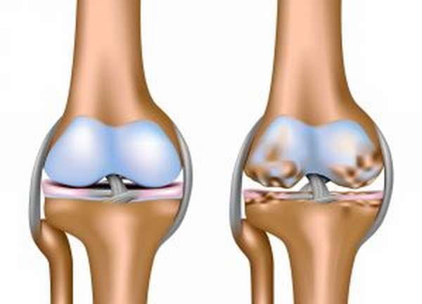 Операция по эндопротезированию коленного сустава